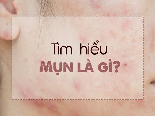 Mụn là gì? Những nguyên nhân gì gây ra mụn?